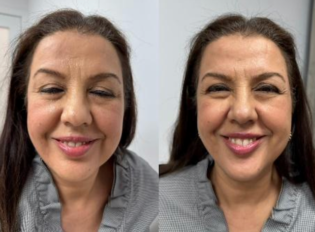 Facial Rejuvenation Before & After 1