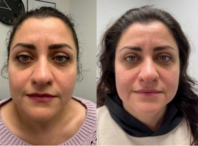Facial Rejuvenation Before & After 2